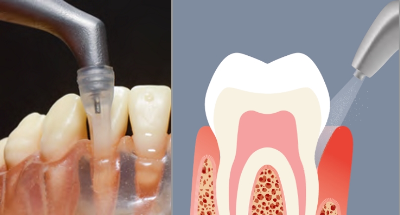 Higienizacja poddziąsłowa kieszeni periodontologicznych 